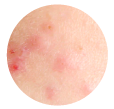 Impurezas